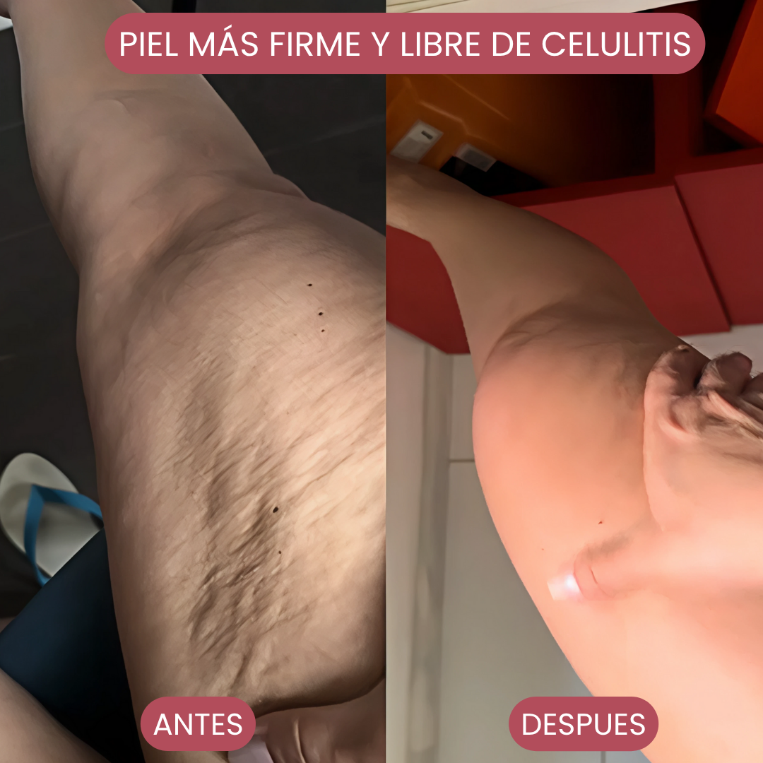 Kit Body Light: Ventosa Térmica + Crema Lipo Reductora