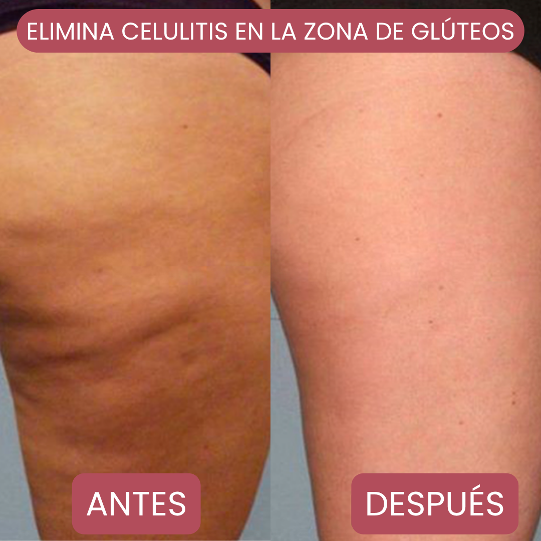 Kit Body Light: Ventosa Térmica + Crema Lipo Reductora